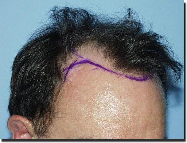 Hair restoration procedure results