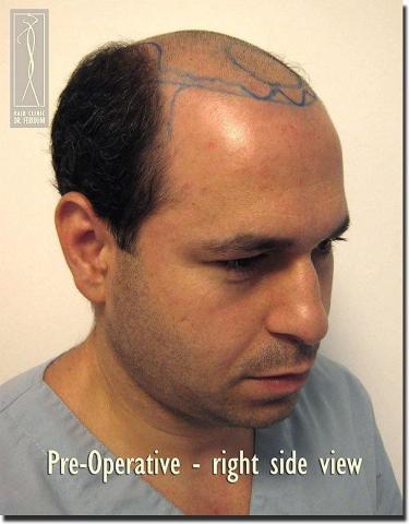 Hair restoration procedure results