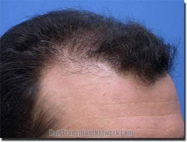 Hair restoration procedure results