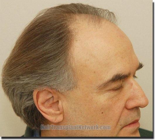 Hair restoration procedure results