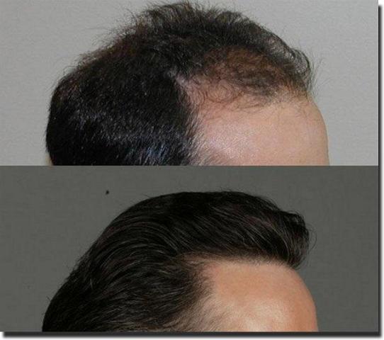 Hair restoration procedure results