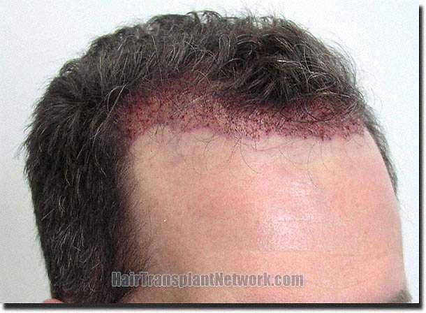 Hair restoration procedure results