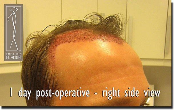 Hair restoration procedure results