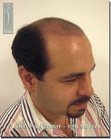 Hair restoration procedure results