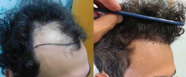 Right of patient, before and results of hair transplant