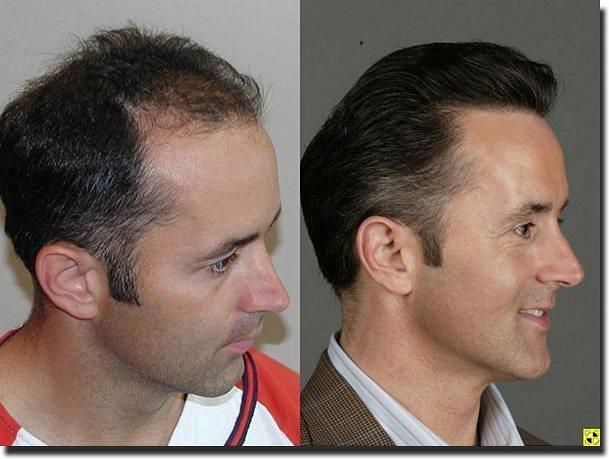 Hair restoration procedure results