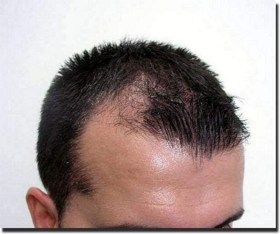 Hair restoration procedure results