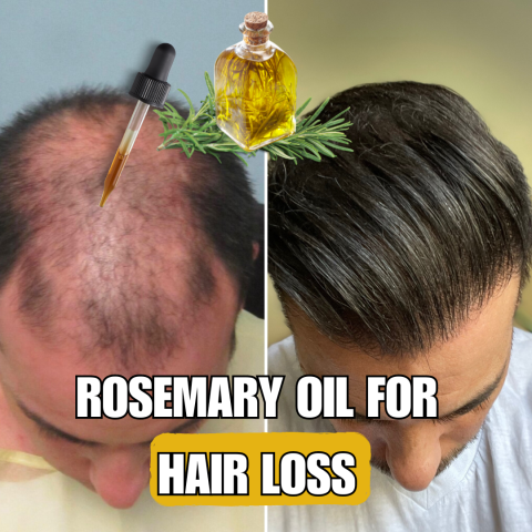 Does Rosemary Oil Stop Hair Loss