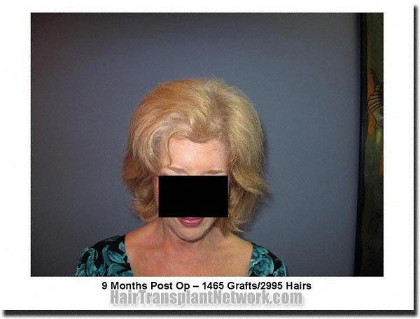 Hair restoration procedure results