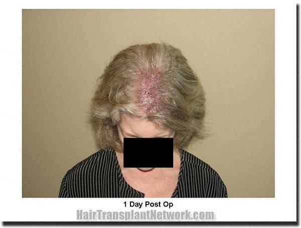 Hair restoration procedure results