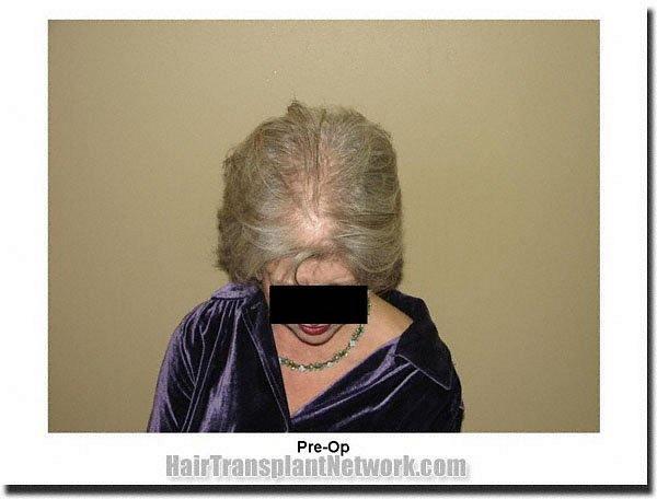 Hair restoration procedure results