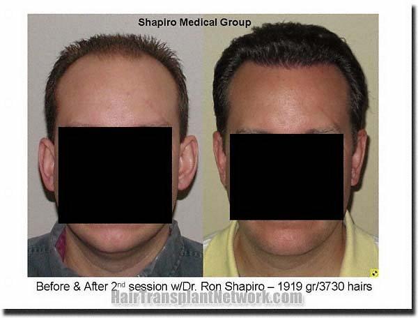 Hair restoration procedure results