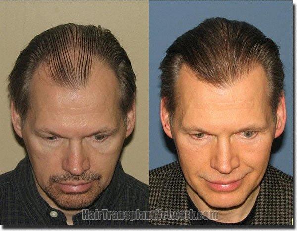 Hair restoration procedure results