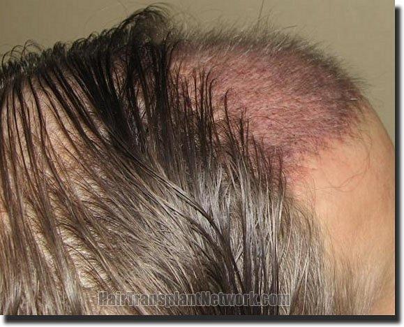 Hair restoration procedure results