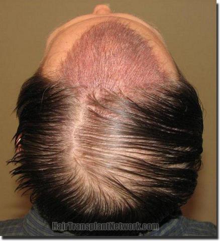 Hair restoration procedure results