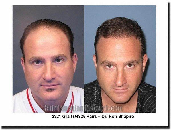 Hair restoration procedure results