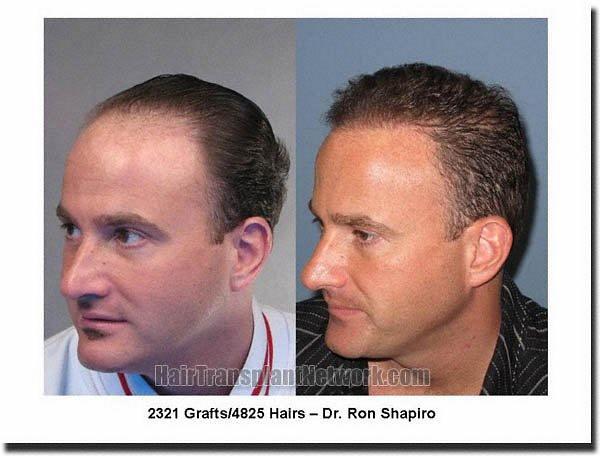 Hair restoration procedure results