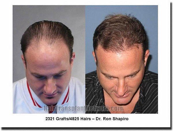 Hair restoration procedure results