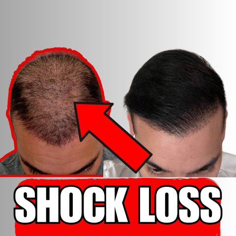 News: How Long Does Shock Loss Last After A Hair Transplant