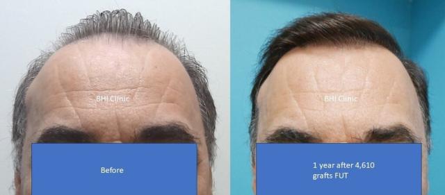 Frontal Hairline Comparison