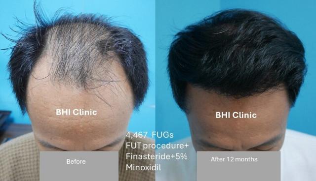 Diffuse Hair Loss Before and After