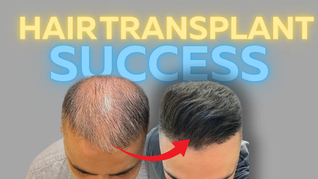 Hair Transplant Success Rates ✅: What You Need to Know