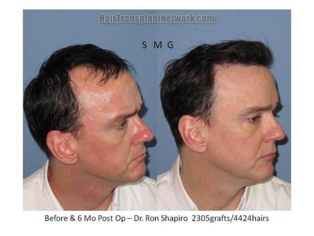 Before and after surgical hair restoration procedure