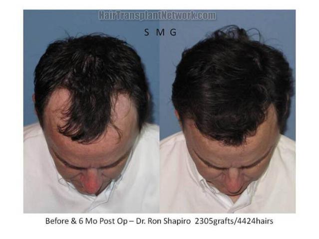 Top view before and after hair restoration images