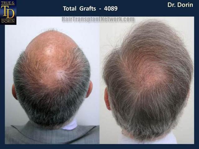 Before and after photos of hair transplant procedure