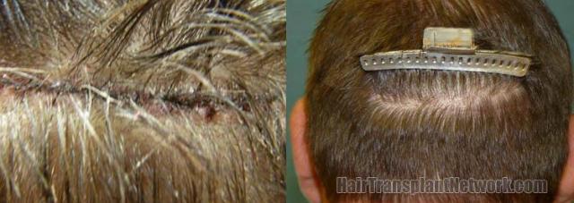 Residual scar photo before and after images