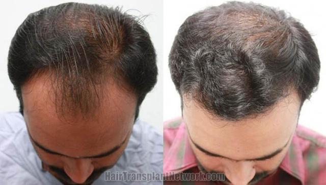 Before and after images hair transplant procedure