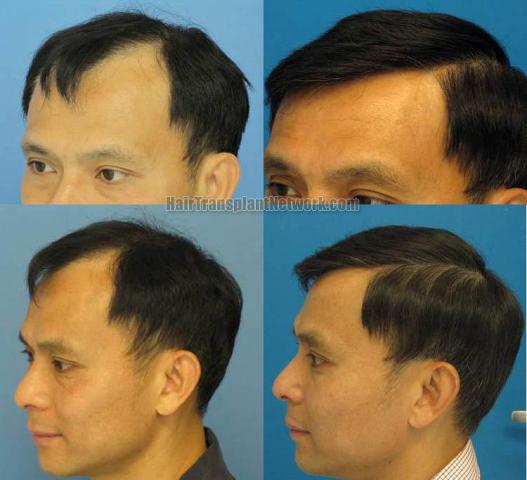 Surgical hair replacement before and after images