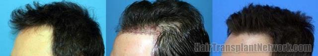 Left view - Before and after hair restoration procedure