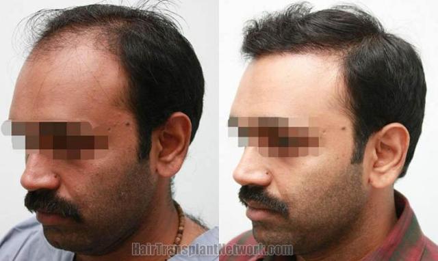 Left view before and after hair restoration procedure