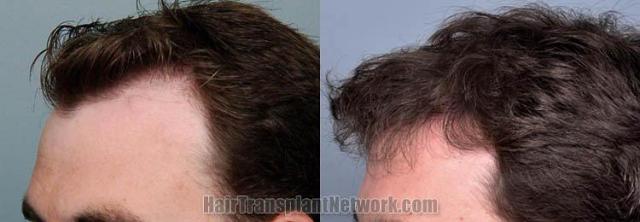 Hair transplantation surgery before and after images