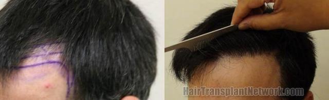 Left view before and after hair transplantation procedure