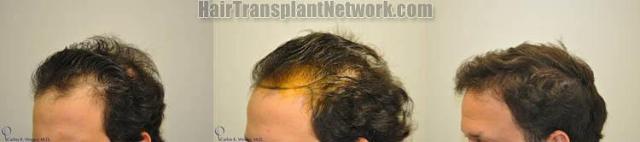 Before and after hair transplantation surgery results