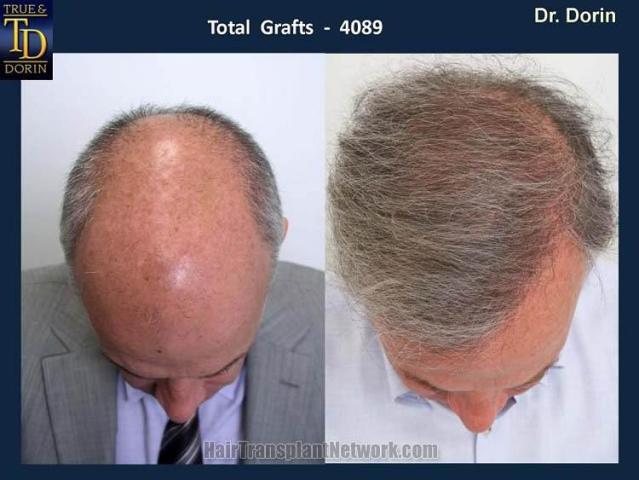 Top view - Before and after hair transplantation image