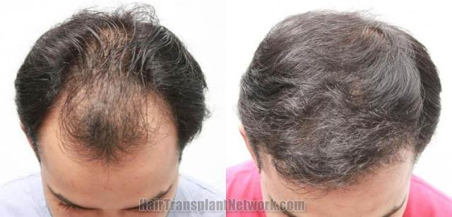 Hair transplantation procedure result photos