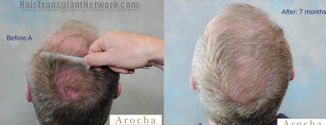 Before and after hair restoration procedure results