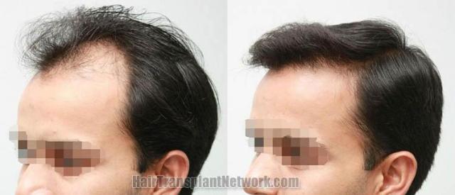 Left view  - Before and after surgical hair replacement