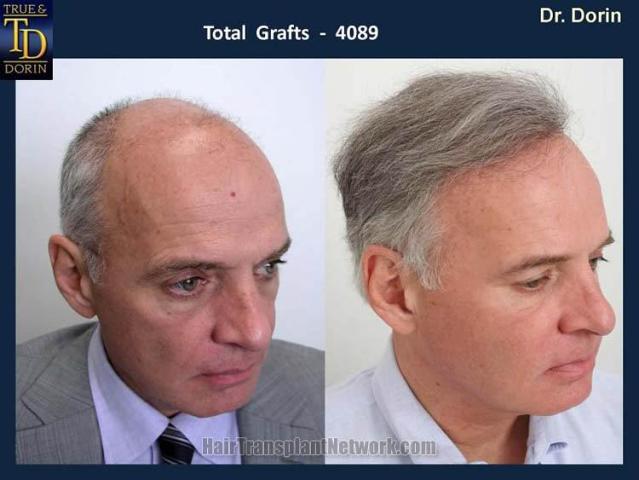 Before and after hair transplant procedure photograph