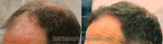 Before and after hair replacement - Left view