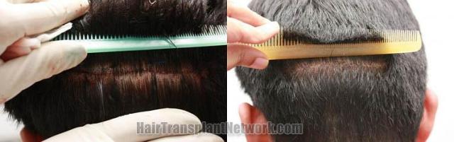 Residual scar of hair transplant recipient images