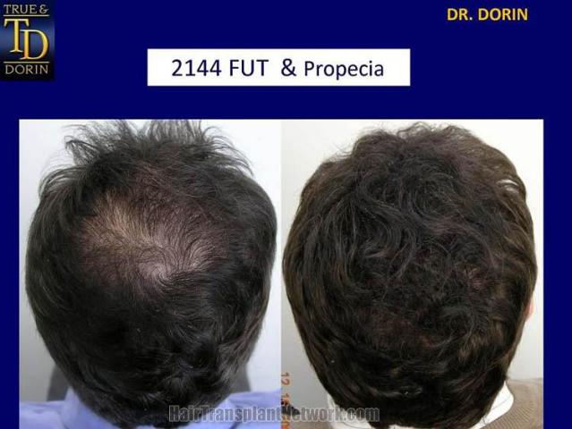 Back view before and after hair transplantation photos