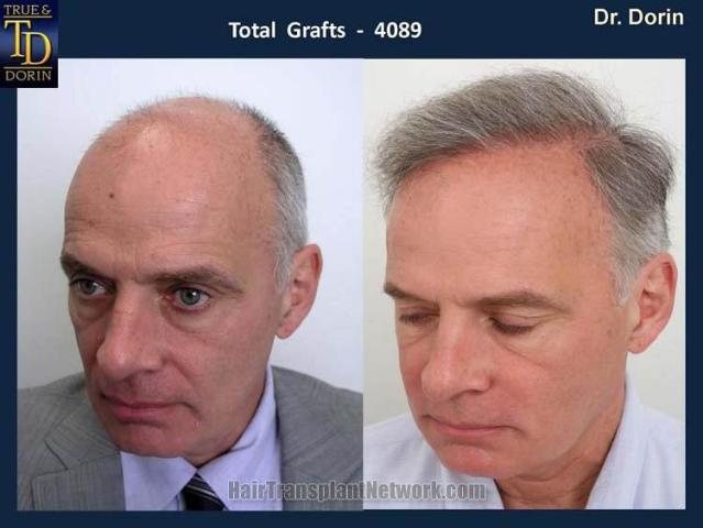 Left view - Before and after hair transplant results