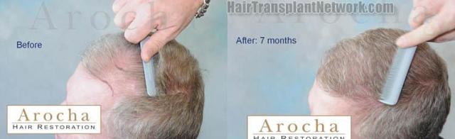 Left view - Before and after hair transplantation images