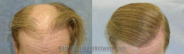 Before and after hair transplantation procedure and repair