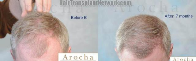 Hair restoration procedure before and after images