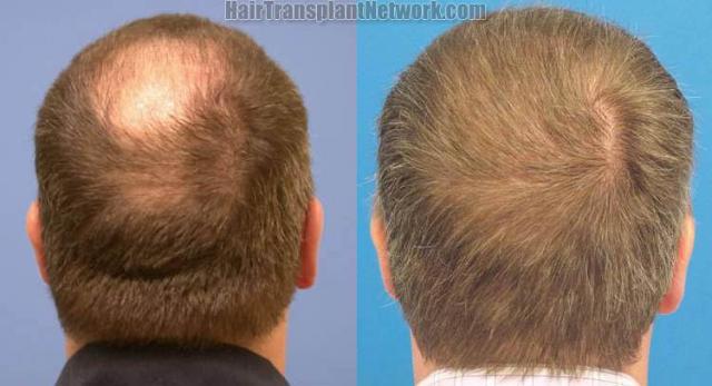 Back view before and after hair transplant procedure